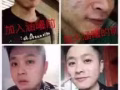 改善痘痘肌，敏感肌，痘印，改善皺紋，美白淡斑！