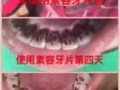 煙斑，黃牙牙齦過敏剋星，美牙牙片，隨時隨地刷牙，擺脫牙刷