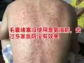 祛痘祛痘，天然的臭氧油，帶你祛痘不留痕