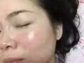 祛痘祛痘，天然的臭氧油，帶你祛痘不留痕