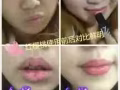 修复受损唇部