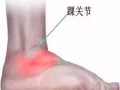 关节炎、颈椎病、耳疗、足部矫正、脊椎矫正， 免开刀免吃药疼痛奌缓解