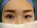眼睛蛻變完美，美美噠[玫瑰][玫瑰][玫瑰]趕快約吧！