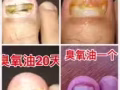 灰指甲，腳氣，痔瘡，痘痘，純天然治療