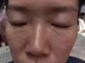 一次性去除各种斑