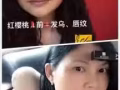 修复受损唇部或者纹过唇的