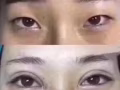 纳米无痕双眼皮