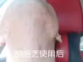 七天祛痘十天無印還你一個健康美麗的臉