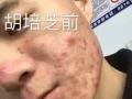 祛痘交给我美丽留给你