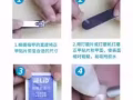 专业治疗甲沟炎。嵌甲。阴沟。