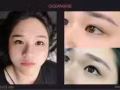 私人訂製零麻藥眉眼唇活動中