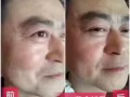 GPT线雕护理，5分钟见效！！！