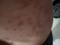 牛皮癣特效中药，我自己在中国看的中医药买一个月，现在15天病好了多15天药，有需
