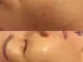 水光疗程