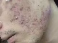 純中草藥祛痘七天見效