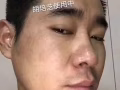 純中草藥祛痘七天見效
