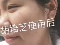 祛痘不反彈