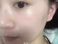 祛痘膏