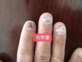 灰指甲的克星