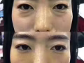 最新科技 水除皱 红细胞面部激活 瘦脸 瘦腿瘦肩 小脸针 水光针 太阳穴下巴