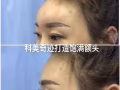 最新科技 水除皺 紅細胞面部激活 瘦臉 瘦腿瘦肩 小臉針 水光針 太陽穴下巴