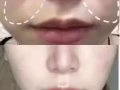 最新科技 水除皺 紅細胞面部激活 瘦臉 瘦腿瘦肩 小臉針 水光針 太陽穴下巴