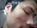 祛痘去印膏