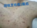 祛痘去印膏
