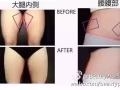 酷塑--冷凍減脂