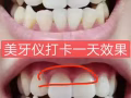 想拥有一口大白牙的点进来 无效退款