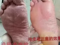 腳氣 陰囊潮濕 剋星