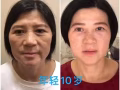 针灸美容/法令纹鱼尾纹川字纹颈纹淡斑提升
