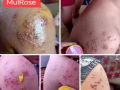 Eczema, rash, dryness, itchy skin,