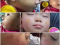 Eczema, rash, dryness, itchy skin,