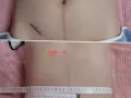 減肥瘦身