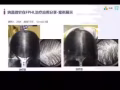 納晶納米技術治療脫髮
