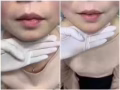 腋下永久脫毛一年$1xx！洗臉$38起。提供瘦臉針等醫美服務。