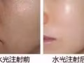 医美微整大优惠