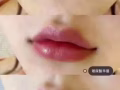 醫美微整大優惠