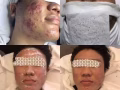 今天打的是痘痘治疗