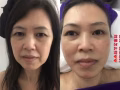 仅38新币抢购价值158新币的专业中医经络疏通眼健康护理