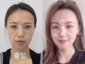美容，微整，水光針，項目大促銷