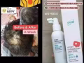 脫髮救星‼️ 脫髮禿頭有救啦‼️【採用珍貴草本配製而成，專為頭皮和脫髮問題者研發的健頭皮健發產品】