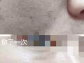 祛斑，美白