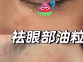 无痛去除 油粒 油泡 脂肪粒