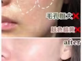 麗絲塔小金盒水光中的愛馬仕！專業機打水光針！