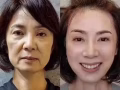 悄悄变美-去除法令纹 年轻10岁