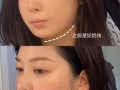 悄悄变美 无痕无疤 想瘦哪里瘦哪里