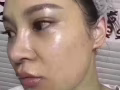 痘痘的克星
