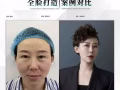明星体验价$200任选以下的一个脸部项目（抬头纹,川字纹,提眉双眼皮,眼袋,水光针,瘦脸针,溶脂,去皱,填充下巴嘟嘟唇）